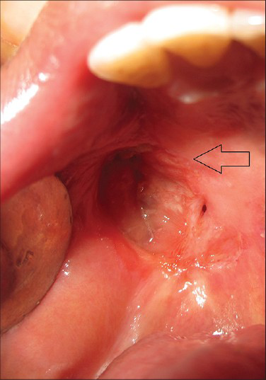 45-year-old male patient with lesion on the right side of the palate diagnosed as mucoepidermoid carcinoma – intermediate stage. Post treatment intra-oral photograph shows complete healing of the tumor site (arrow).